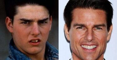 Tom cruise's teeth before and after photos and dental procedure