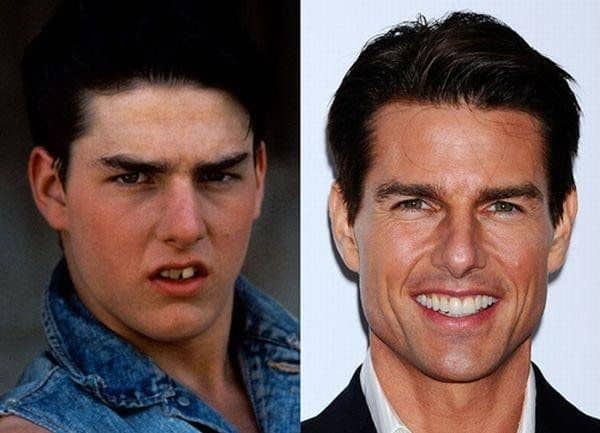 tom cruise smile then and now