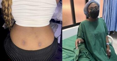 Lady lands in the hospital after getting a back dimple piercing