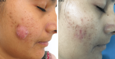 Cystic Acne: Causes, Treatment, Prevention