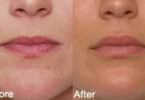 Minimize Lip Lines, According To Experts