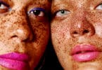 Ways To Treat Hyperpigmentation