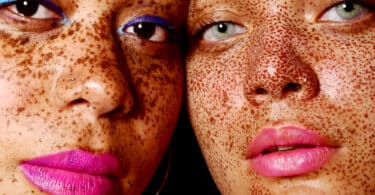 Ways To Treat Hyperpigmentation