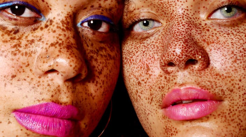 Ways To Treat Hyperpigmentation