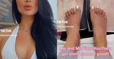 Woman mocked on Tiktok after getting toe-shortening surgery that looks worse