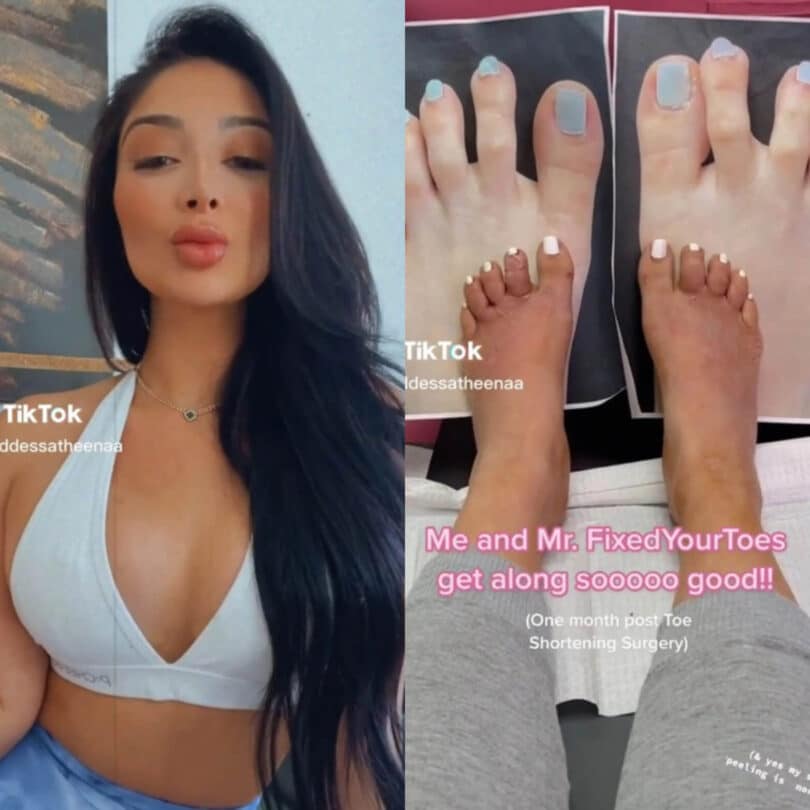 Woman mocked on Tiktok after getting toe-shortening surgery that looks worse