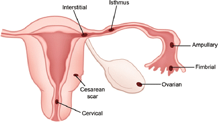 Ectopic Pregnancy- Causes| Risk factors |Symptoms| Diagnosis| Treatment| Prevention| Outlook