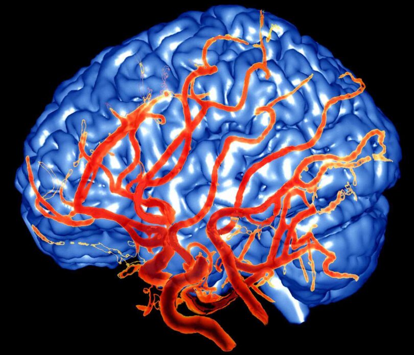 The Role of Beta-Blockers for Migraine Prevention