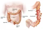 All About Diverticulitis: 9 Home Remedies And Natural Treatments