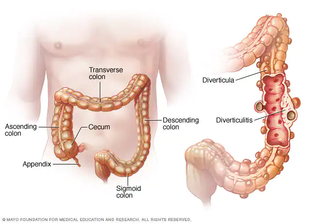 All About Diverticulitis: 9 Home Remedies And Natural Treatments