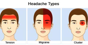 Migraines vs. tension headaches vs. cluster headaches