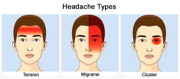 Migraines vs. tension headaches vs. cluster headaches