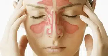 Know All About Sinusitis