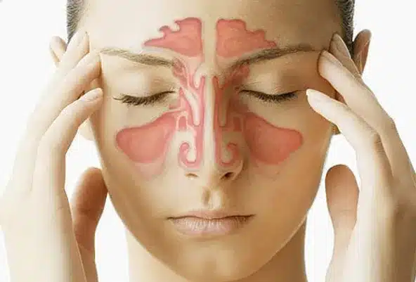 Know All About Sinusitis