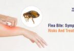 What do Flea Bites look like? Symptoms and Treatment