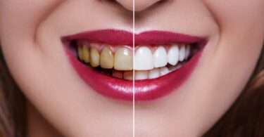 How Long Does Teeth Whitening Last?