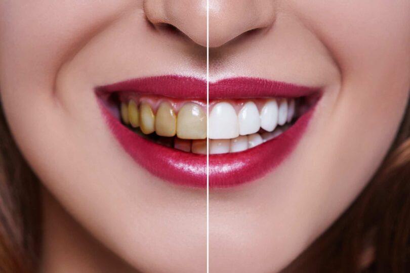 How Long Does Teeth Whitening Last?