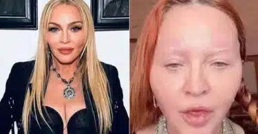 Madonna Plastic Surgery