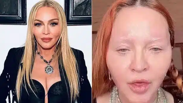 Madonna Plastic Surgery