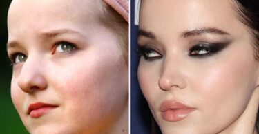 Dove Cameron Plastic Surgery