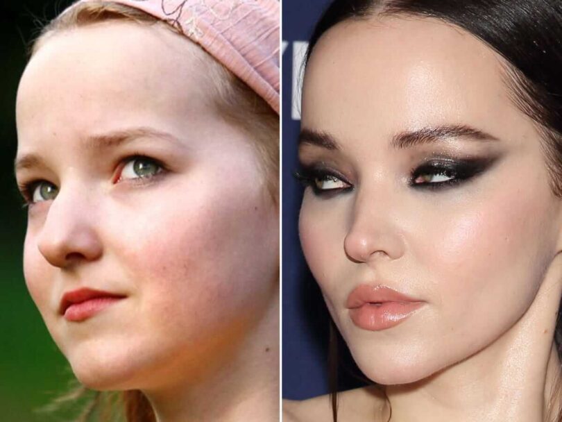 Dove Cameron Plastic Surgery