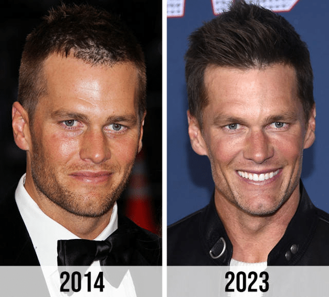 Tom Brady Plastic Surgery