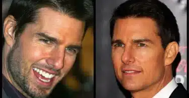 Tom Cruise Plastic Surgery